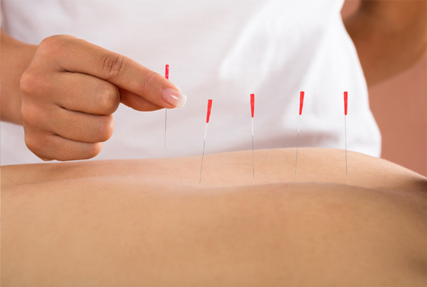 Dry Needling Therapy